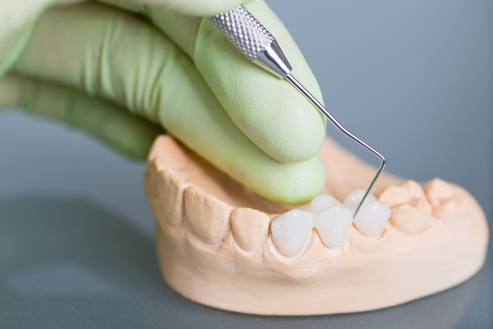 dental bridge